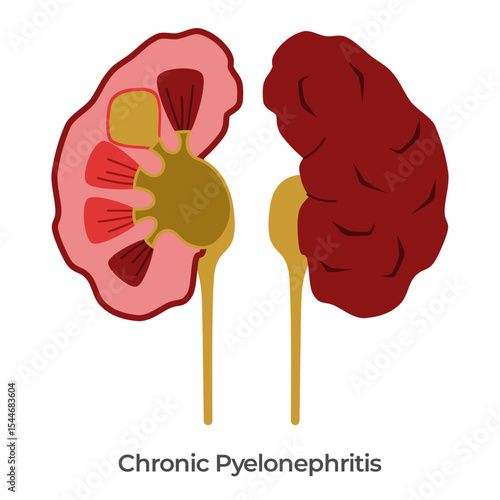 Kidney Pyelonephritis kidneys bacterial infection anatomy drawing illustration