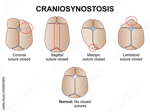 Craniosynostosis premature fusion of sutures illustration