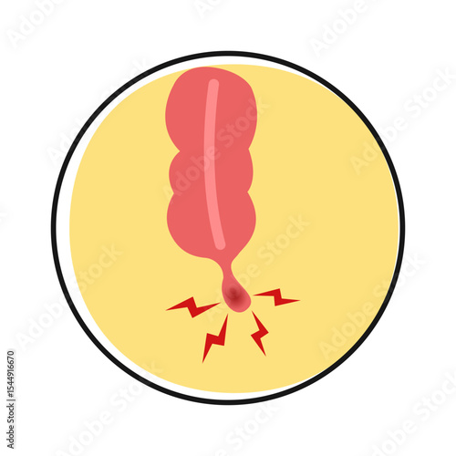 Cartoon of appendicitis symptoms