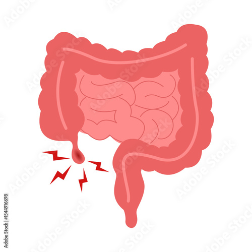 Cartoon of appendicitis symptoms