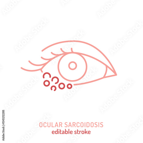 Ocular sarcoidosis icon. Editable vector illustration of granulomatous inflammation in the eye.