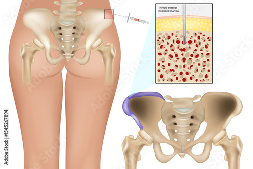 Bone Marrow Aspiration Procedure from Posterior Iliac Crest. Medical Illustration of Bone Marrow Biopsy Site in Pelvic Bone. Bone Marrow Extraction Technique