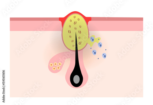 Cross Section of Inflamed Red Acne (Papule)