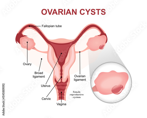 Ovarian Cysts, fluid-filled sacs illustration