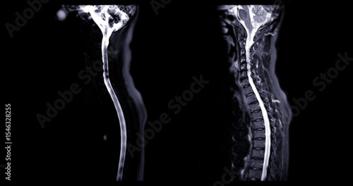 Quadro em tela The MRI scan of the cervical spine shows detailed imaging of the vertebrae and spinal cord, highlighted in vibrant pink