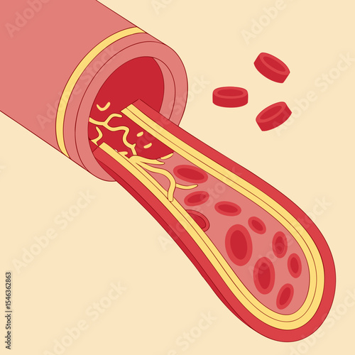 3D Illustration of Atherosclerosis in Blood Vessel – High Cholesterol Symptoms