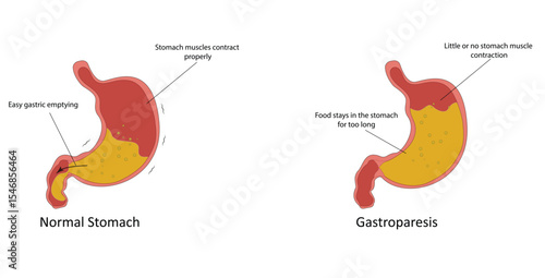 Gastroparesis vector illustration