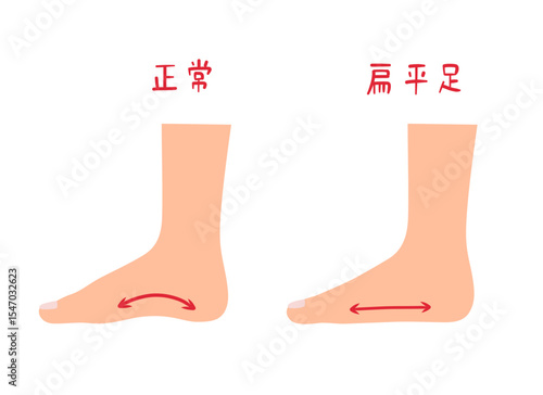 偏平足と正常な足のセットイラスト