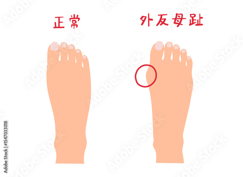 外反母趾と正常な足の主線なしシンプルイラストセット