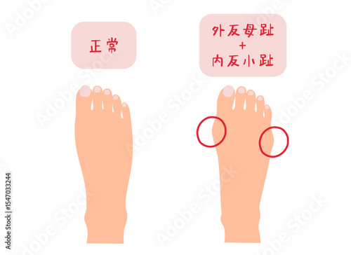 外反母趾と内反小趾と正常な足の主線なしシンプルイラスト素材