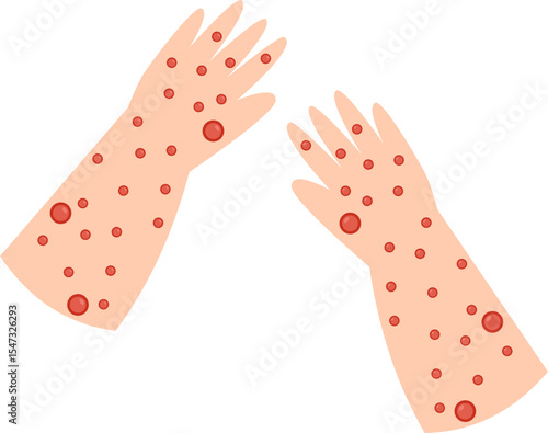 Skin Condition: Red Rash on Arms and Hands Illustration