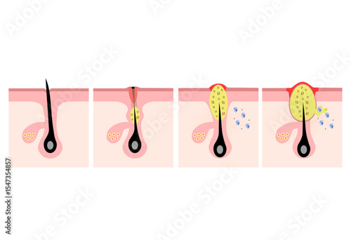 Acne Progression Illustration – From Clogged Pore to Inflammatory Pimple

