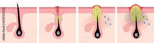 Acne Progression Illustration – From Clogged Pore to Inflammatory Pimple

