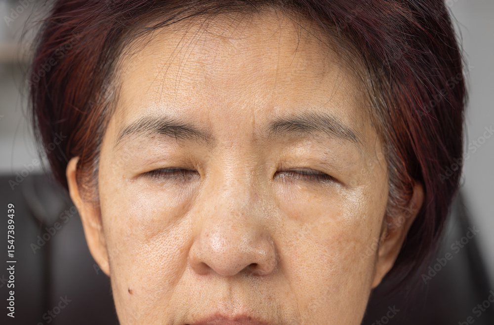 Obraz premium Senior asian woman is periorbital eye fatigue.