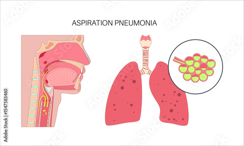 Aspiration pneumonia infection