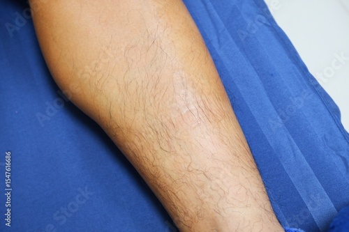 Close up of Leg with Dark Specks on Light Brown Skin After Treatment