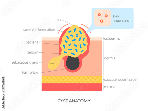 Cyst anatomy flat vector illustration. Medical infographic showing skin structure, sebum buildup, inflammation and surface view. Skincare and dermatology concept.