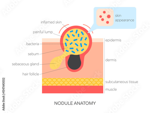 Nodule anatomy flat vector illustration. Medical infographic showing skin structure, sebum buildup, inflammation and surface view. Skincare and dermatology concept.