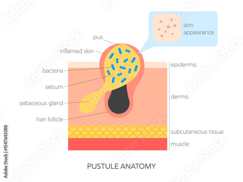 Pustule anatomy flat vector illustration. Medical infographic showing skin structure, sebum buildup, inflammation and surface view. Skincare and dermatology concept.