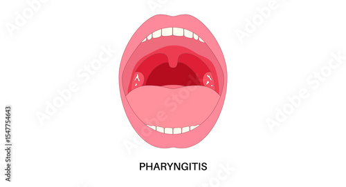 Pharyngitis oral disease