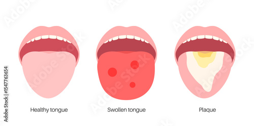 Tongue disease poster