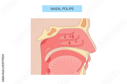 Nasal Polyps poster