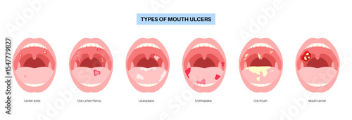 Types of mouth ulcer