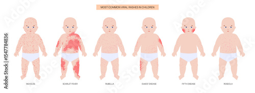 The most common viral rashes