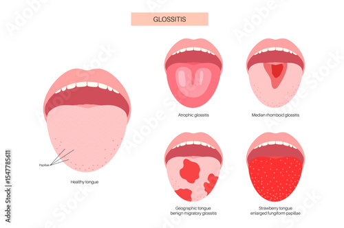 Tongue disease poster