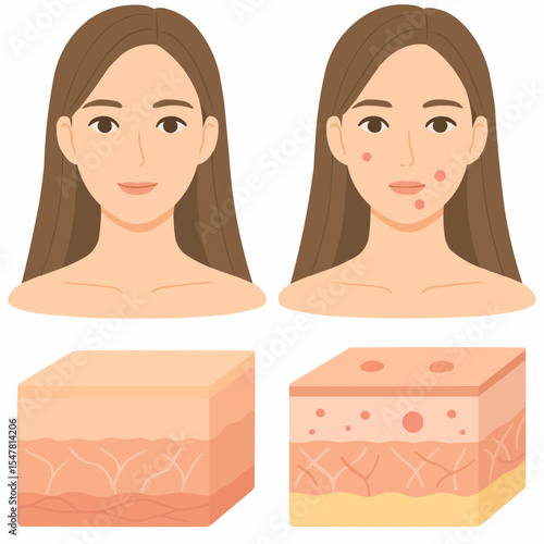 20代女性の顔・ニキビ・肌構造の比較イラスト