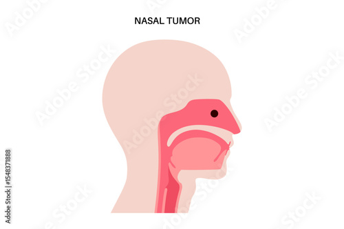 Nasal cancer poster