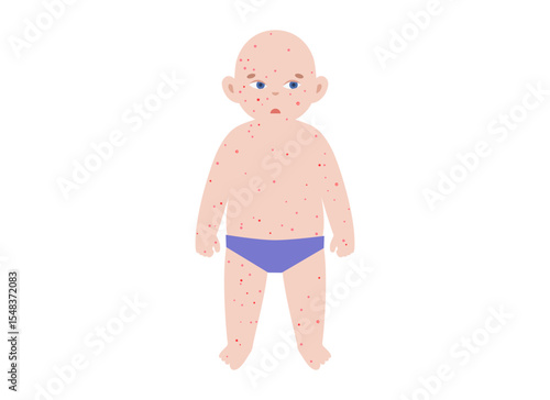 The most common viral rashes