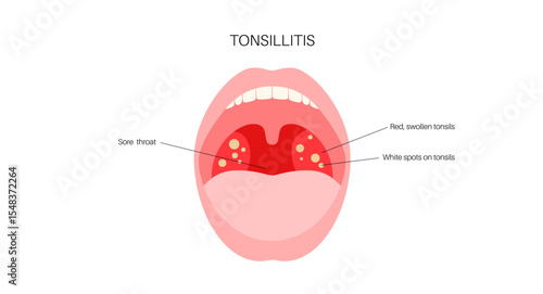 Tonsillitis Oral Desease