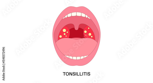 Tonsillitis Oral Desease