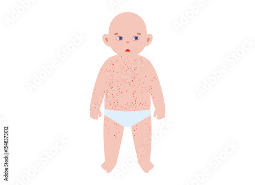 The most common viral rashes