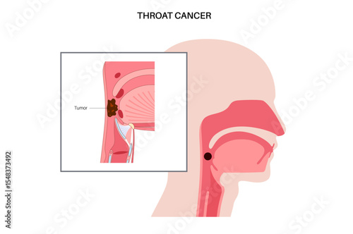 Throat cancer poster