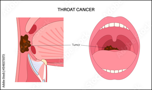 Throat cancer poster
