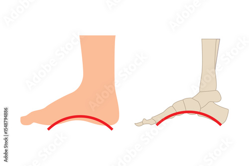 Feet with too high arches, feet with high arches