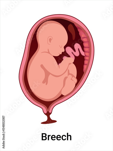 Breech baby positions in the uterus during pregnancy. Pathology. Detailed medical vector illustration. Fetus with umbilical cord, placenta.
