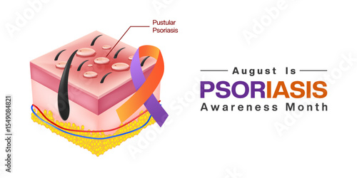 August is Psoriasis Awareness Month. Pustular psoriasis and ribbon. Suitable for posters, banners and social media. White background.