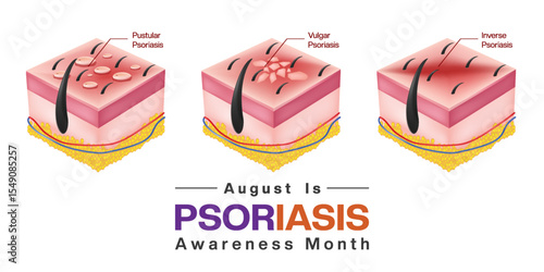 August is Psoriasis Awareness Month. Pustular psoriasis,  vulgar psoriasis and inverse psoriasis.  Suitable for posters, banners and social media. White background.