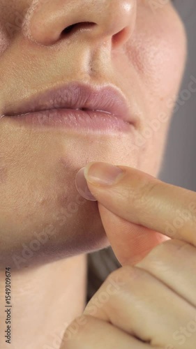 Vertical video of woman applying patches to treat acne on her face. Close up, 4k footage.