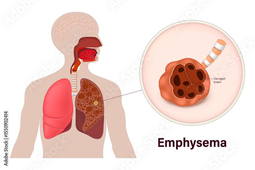 Emphysema. Damaged alveoli. Lung diseases anatomy. Human respiratory system.