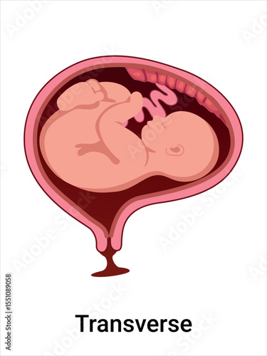 Transverse baby positions in the uterus during pregnancy. Pathology. Detailed medical vector illustration. Fetus with umbilical cord, placenta.
