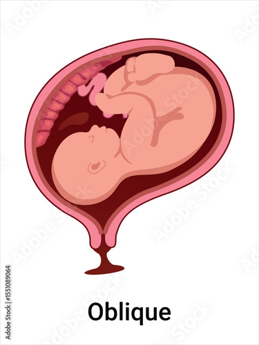Oblique baby positions in the uterus during pregnancy. Pathology. Detailed medical vector illustration. Fetus with umbilical cord, placenta.
