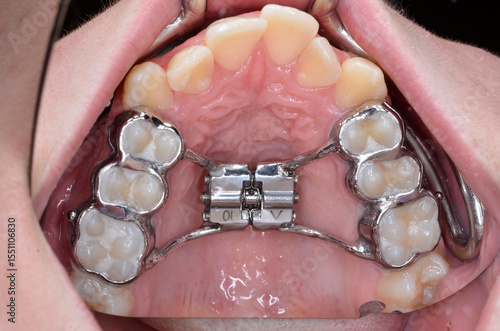 palatal expander in situ