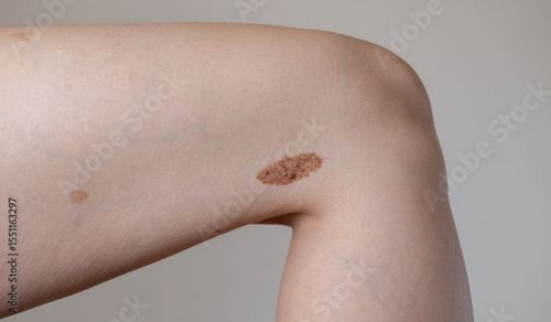 Foto symmetrical benign convex nevus (birthmark) on a woman's leg, healthy skin condi
