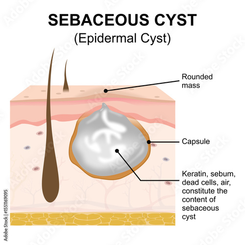 Epidermal (Sebaceous) or Skin Cyst Illustration