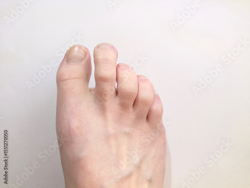 Close up of a woman's bare foot with claw toes.