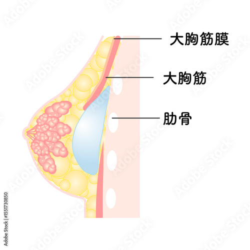 バッグ豊胸_デュアルプレーン法